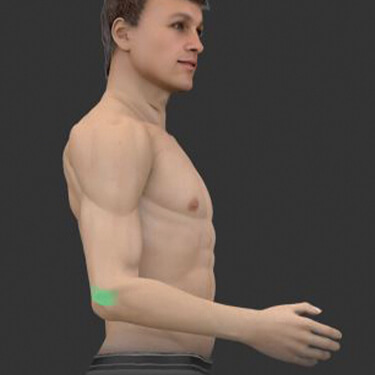 Epicondylitis